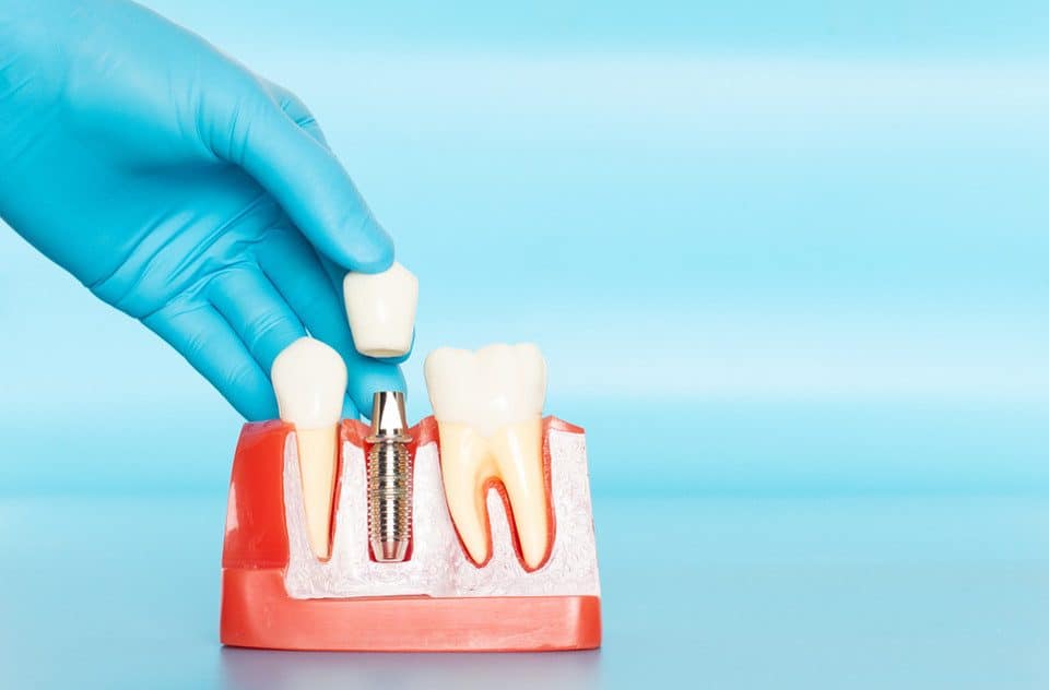 modelo de manequim com os tipos de implantes dentarios