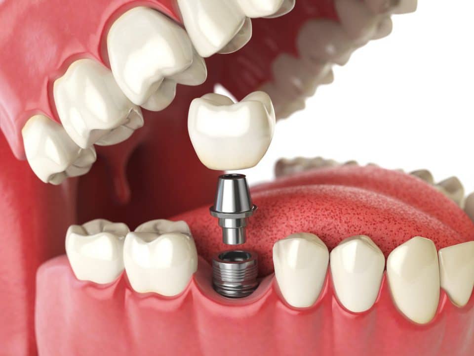 ilustração do procedimento cirúrgico para colocação do implante dentário