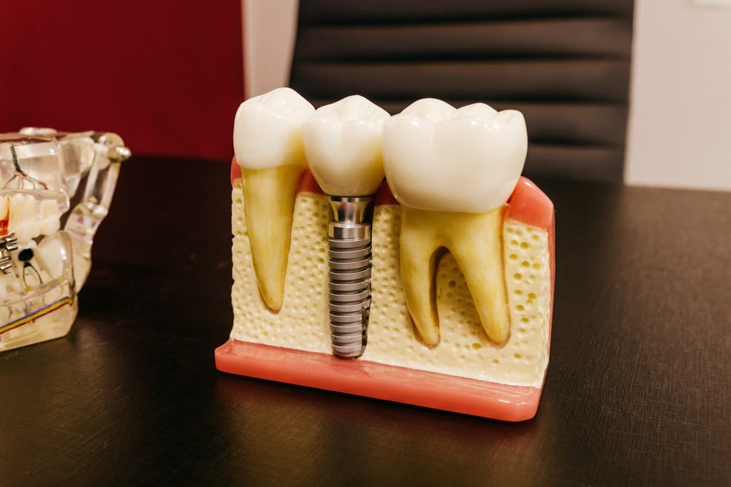 manequim de molde exemplificando as vantagens do implante dentário