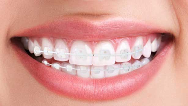 Conheça o aparelho ortodontico estético de Sáfira  recalcado vai cair de costa' quando  Starting Point  recalcado vai cair de costa' quando verso 1:</p>     </aside>     <aside>         <a href=