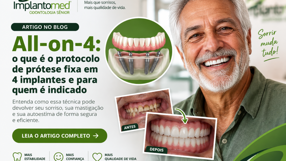 Prótese fixa All-on-4 sustentada por quatro implantes dentários