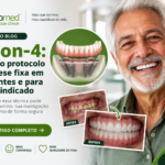 Prótese fixa All-on-4 sustentada por quatro implantes dentários