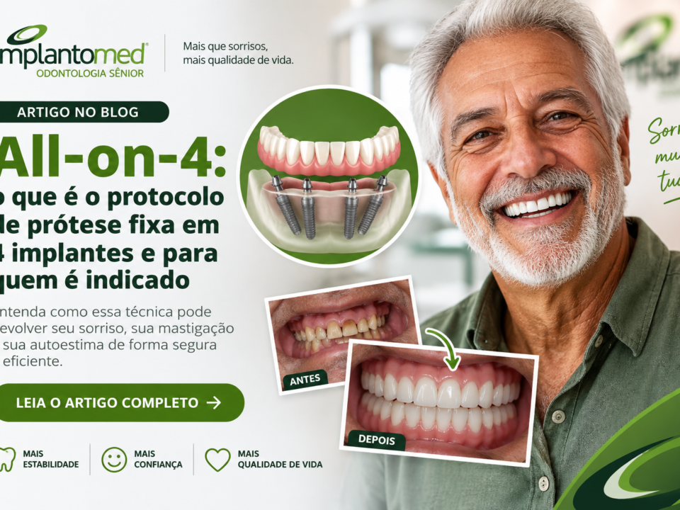 Prótese fixa All-on-4 sustentada por quatro implantes dentários